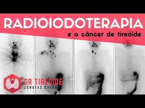 Radioiodoterapia e o câncer de tireóide - Dr Tireóide Responde