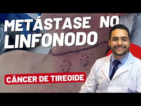 Metástase para o linfonodo no Câncer de tireoide