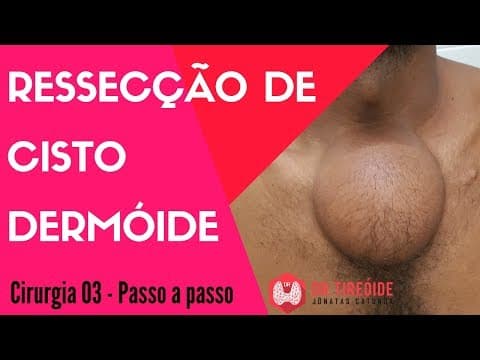 Cisto Dermóide Volumoso - Cirurgia Passo a passo | Dr Jônatas Catunda