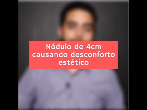 Nódulo na tireóide de 4cm causando desconforto estético