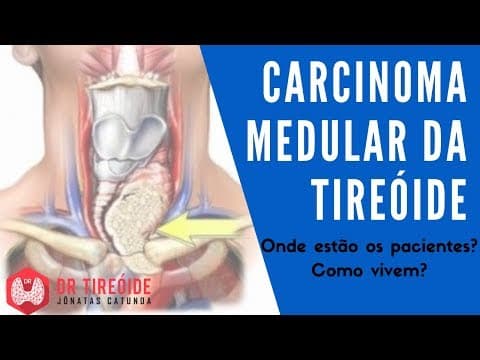 Carcinoma Medular da tireóide - Dr Tireóide Responde