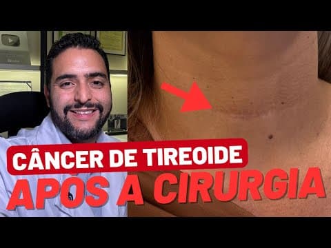 Câncer de tireoide: como é o acompanhamento após a cirurgia?