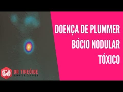 Doença de Plummer, o bócio nódulo tóxico, causa de hipertireoidismo | Dr Jônatas Catunda