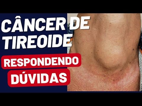 Câncer de Tireoide: Esclarecendo as Dúvidas Mais Comuns