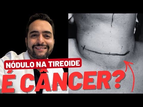 Todo nódulo na tireoide é câncer?