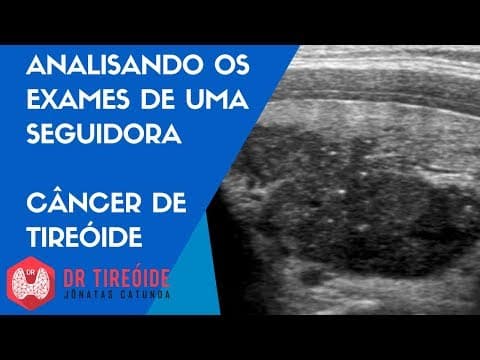 Analisando os exames de uma seguidora sobre câncer de tireóide | Dr Tireóide Responde