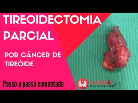 Tireoidectomia parcial por câncer de tireóide - Cirurgia Passo a passo | Dr Jônatas Catunda