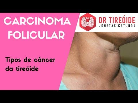 Carcinoma Folicular - Tipos de câncer de tireóide | Dr Jônatas Catunda