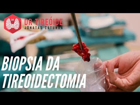 Resultado da biópsia da tireoidectomia - Como interpretar? | Dr Jônatas Catunda