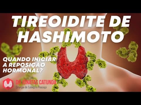 Tireoidite de Hashimoto: Quando iniciar a medicação?