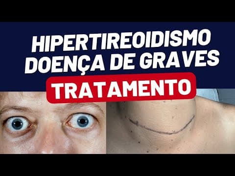 TRATAMENTO DA DOENCA DE GRAVES HIPERTIREOIDISMO