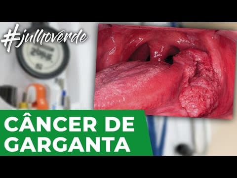 Câncer de orofaringe | Campanha Julho Verde