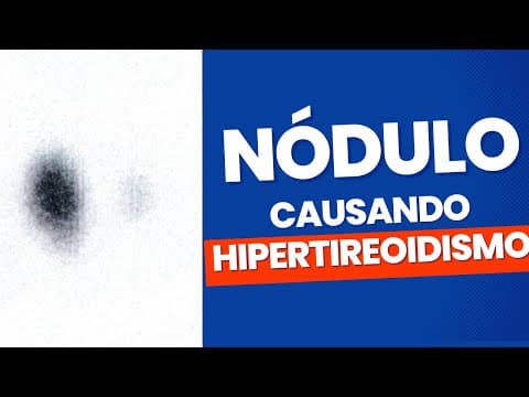 Doença de Plummer: Nódulo causando hipertireoidismo