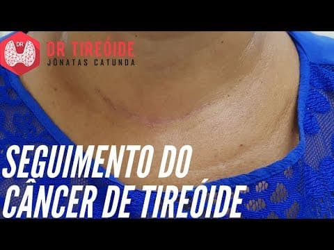 Acompanhamento do câncer de tireóide - Tireoglobulina? Anti-tireoglobulina? Ultrassom?