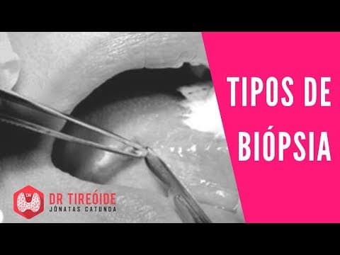 Tipos de biópsia - Incisional, excisional, PAAF, CORE... | Dr Jônatas Catunda