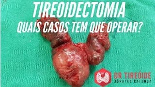 Quem precisa fazer a tireoidectomia? | Dr Jônatas Catunda