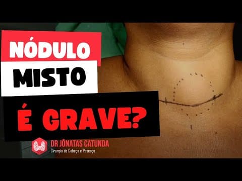 Nódulo misto na tireóide é grave? - Ao vivo respondendo perguntas