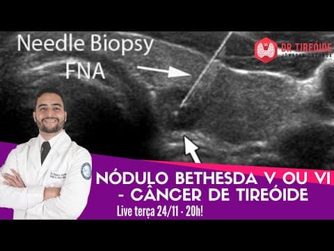 Nódulo Bethesda V e VI - Câncer de tireóide - Dr Tireóide responde