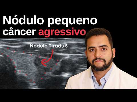 O erro de achar que todo câncer pequeno da tireoide é tranquilo