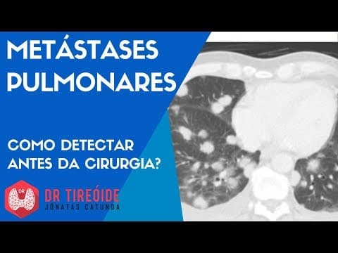 Metástases pulmonares do câncer de tireóide - Como detectar antes da cirurgia?