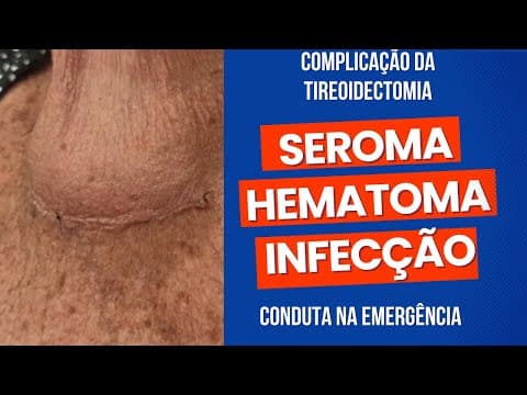 Complicações da tireoidectomia na EMERGÊNCIA - Seroma / Hematoma / Infecção