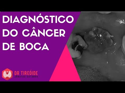 Diagnóstico do câncer de boca - Dr Jônatas Catunda