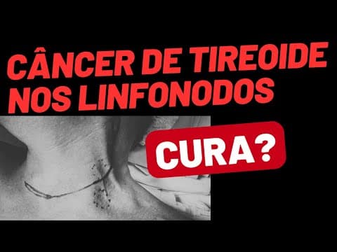 Câncer de tireoide com linfonodos: ainda tem cura?