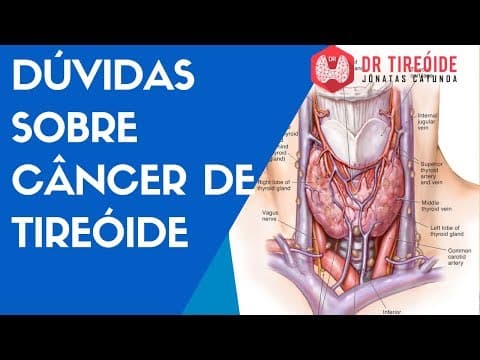 Dúvidas sobre câncer de tireóide - iodoterapia, agressividade | Dr Tireóide Responde