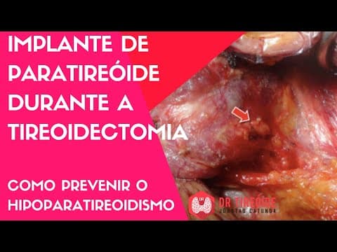 Implante de paratireóide - evitar o hipoparatireoidismo - Cirurgia | Dr Jônatas Catunda
