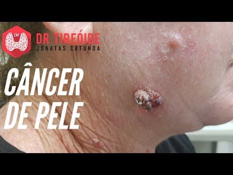 Câncer de Pele | Dr Jônatas Catunda