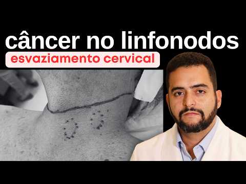 Esvaziamento cervical no câncer de tireoide: riscos, recuperação e quando é necessário