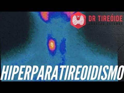 Hiperparatireoidismo - Você conhece essa doença? | Dr Jônatas Catunda