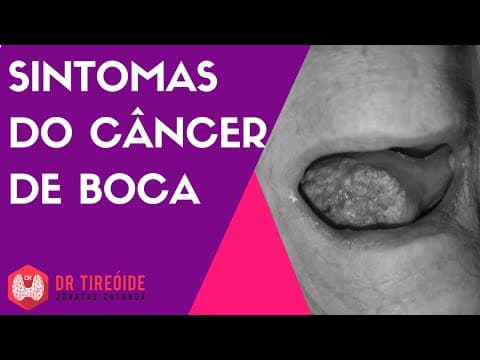 Sintomas do câncer de boca - Dr Jônatas Catunda