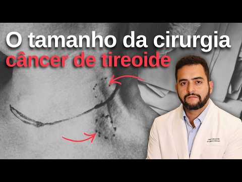 É assim que eu explico a extensão da cirurgia no câncer de tireoide | Dr. Jônatas Catunda
