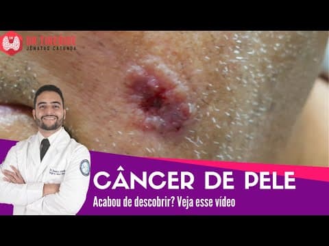 Câncer de pele - Vídeo para quem acabou de descobrir! | Dr Jônatas Catunda