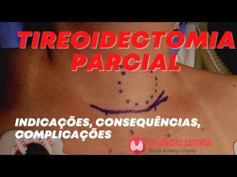 Tireoidectomia parcial - indicações, consequências, complicações