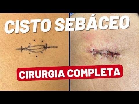 Cisto Sebáceo: Cirurgia Real Filmada passo a passo!