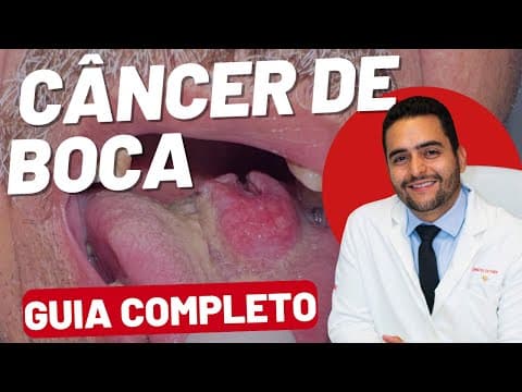 Câncer de Boca: Fotos de Casos, Sintomas, Diagnóstico, Tratamento