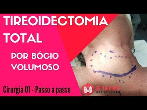 Tireoidectomia total - Cirurgia Passo a passo | Dr Jônatas Catunda