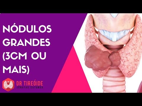 Nódulo de 3cm ou mais na tireóide - Preocupante?