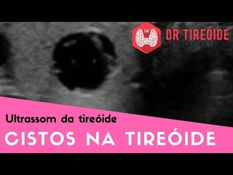 Ultrassom da tireóide - Cisto na tireóide é perigoso? | Dr Jônatas Catunda