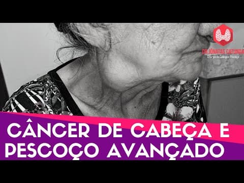 Câncer de cabeça e pescoço avançado - Informações importantes