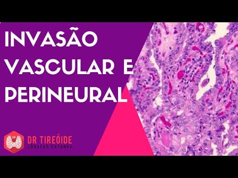 Invasão vascular e perineural - câncer de tireóide