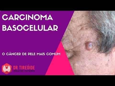 Carcinoma basocelular - O tipo mais comum de câncer de pele
