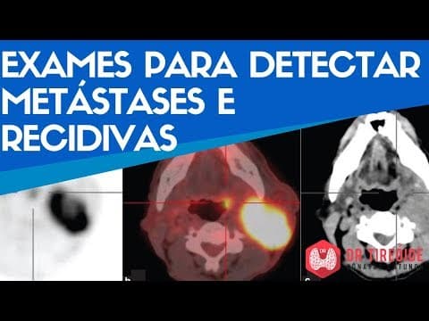 Exames para detectar metástases e recidivas | Dr Tireóide Responde