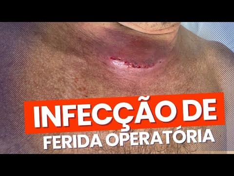 Infecção de ferida operatória do pescoço - tireoidectomia