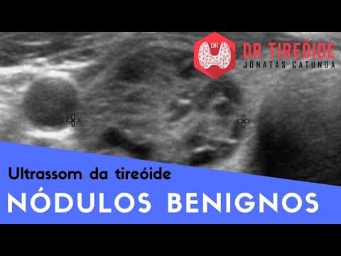 Ultrassom da tireóide - Nódulos benignos! | Dr Jônatas Catunda