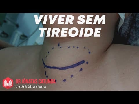 Como é a vida após a cirurgia da tireoide, quais as consequências?