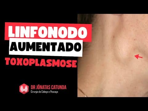 Linfonodo no pescoço aumentado - toxoplasmose