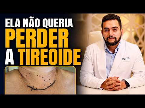 Nódulos benignos na tireoide: por que ela ainda precisou operar
